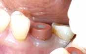 thicken the periimplant soft tissue in cases of thin gingiva biotypes.
