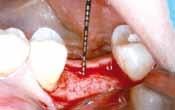 for the thickening of periimplant soft tissue mucosal thickening around bone level implants Dr.