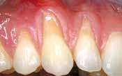 technique) Gingival recessions are not only an aesthetic issue.