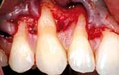 Today, autologous connective tissue grafts are considered the gold standard for the treatment of periodontal recessions; however, harvesting is often a cause of
