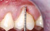 should always be avoided in the treatment of gingival recessions.