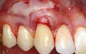 be done with single buttoninterrupted or cross-sutures Gingival