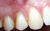 with verti- Multiple gingival recessions