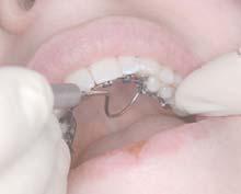 Minimizing binding in highly rotated teeth and avoiding notching, resulting in low friction Ensuring the