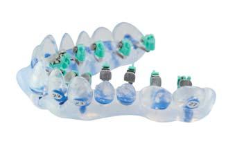 Segmented working Tray bonding Timesaving Teamwork Individual dua tooth bonding and tray bonding The desired bracket positions is encoded in the non-deformable individual transfer cap.