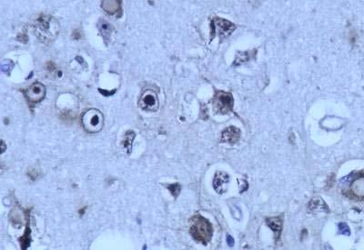 Intranuclear inclusions and cytoplasmic
