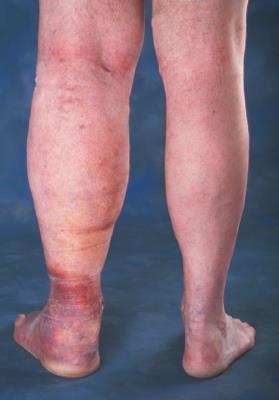 telangiectasias C 6 : Open Skin Ulcers C 5 :