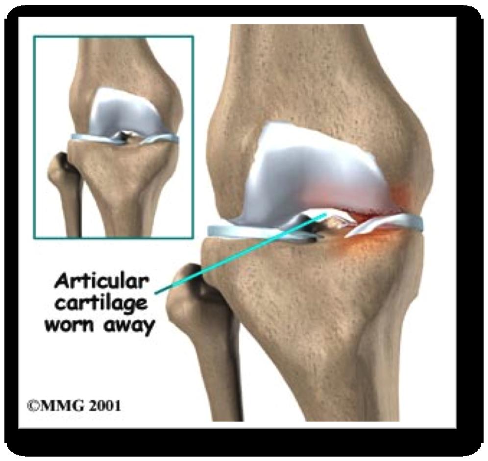Cartilage Injuries Cartilage is designed to absorb shocks and tension. It allows smooth movement of the joint.