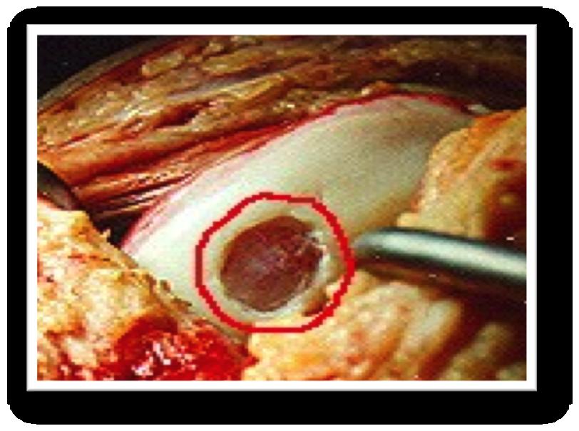Articular cartilage is an avascular tissue structure, incapable of self-repair.