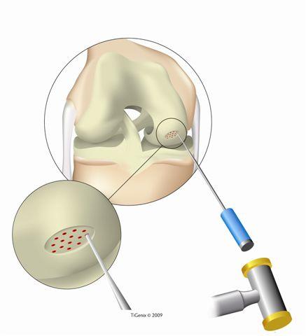Current Solutions Microfracture Gold Standard : Fibrous cartilage tissue regeneration leads to inconsistent long-term results and repeat procedures The Problem Current Microfracture Therapies repairs