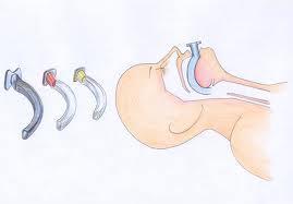 Airway Adjuncts Oro-pharangeal airway (Guedel) Measure from incisors to mandible