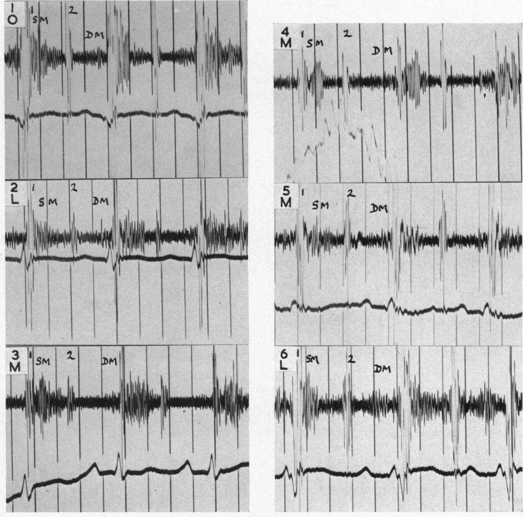 A THE SOUNDS AND MURMURS IN TRANSPOSITION OF THE GREAT VESSELS 749 splitting in one case which was attributed to asynchronous mitral and tricuspid closure. There was no systolic click.