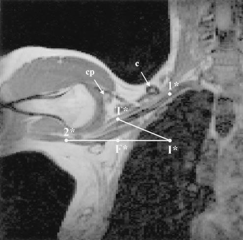 ANESTH ANALG REGIONAL ANESTHESIA AND PAIN MANAGEMENT KLAASTAD ET AL. 595 1999;88:593 8 MRI AND RAJ S INFRACLAVICULAR BLOCK Figure 2. Coronal magnetic resonance image, right side (Volunteer 9).