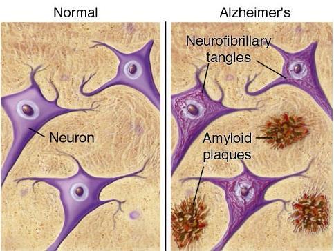 Alzheimer s Disease Not transmissible between individuals Extracellular plaques of protein