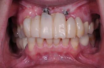 Gingival