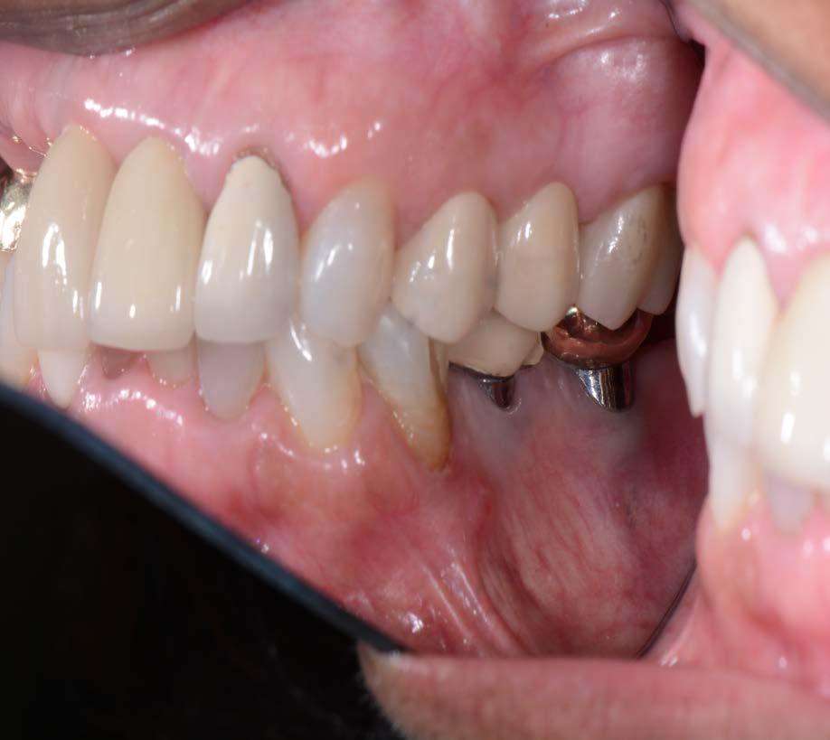 facial gingival recession and did not influence interproximal papilla or