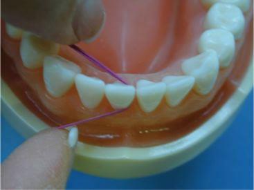 The floss is guided into each interproximal space and then curved in a C-shape around each