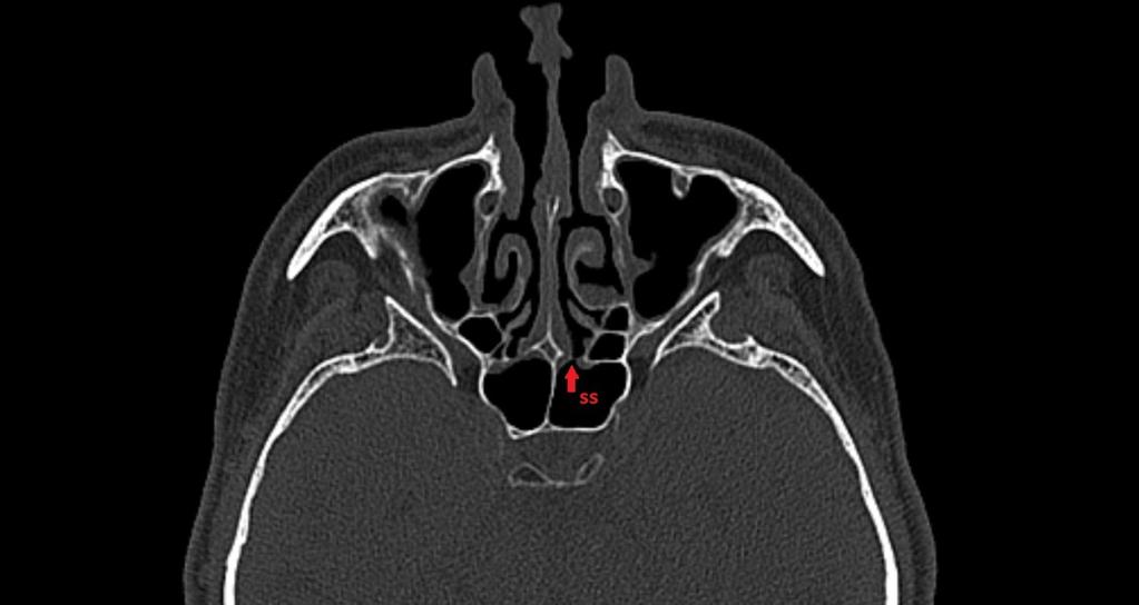 Fig. 7: Coronal CT image shows fovea ethmoidalis (FE), crista galli (CG) and another structure that can be critical during FESS - the cribriform plate (CP).
