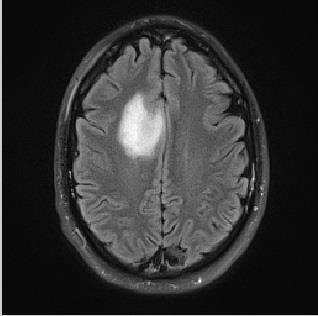 iii) Brain Tumor Segmentation and Classification from Nontumor Tissue: For tumor/nontumor tissue segmentation and classification, MRI pixels are considered as samples.