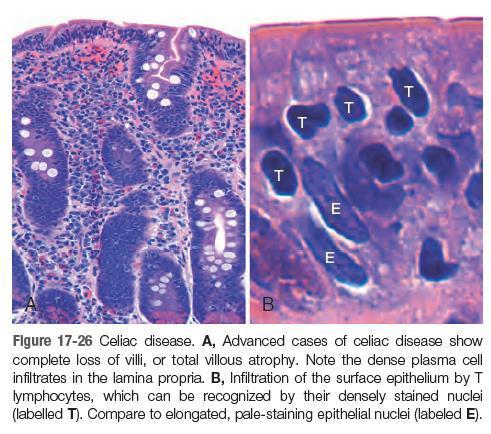 Clinical Features: In adults: celiac disease presents most commonly between the ages of 30 and 60. silent celiac disease: defined as positive serology and villous atrophy without symptoms.