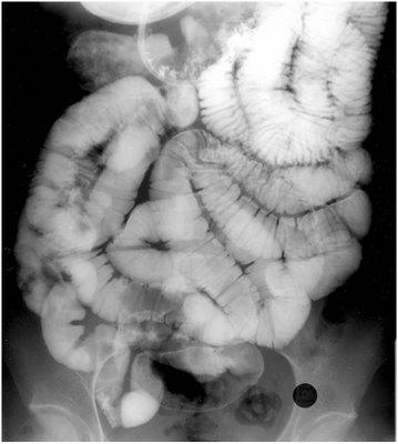 Manage short bowel syndrome with acid suppression therapy Likelihood or resuming an oral diet Amount of bowel remaining Type of bowel remaining Presence of a colon and ileocecal valve Intestinal