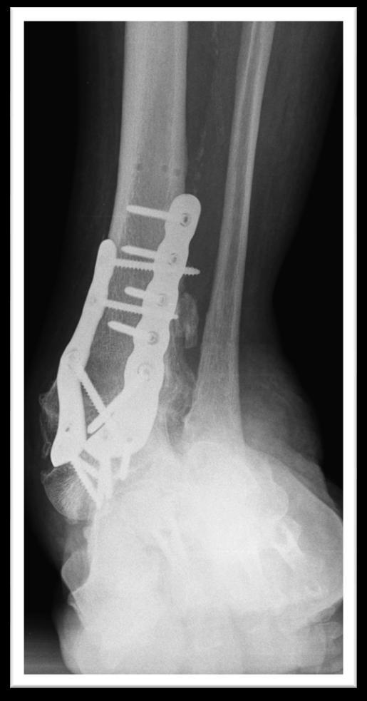 Introduction - We have seen 4 patients with a peritalar dislocation beneath the successfully healed tibiotalar fusion for an AAFD stage IV.