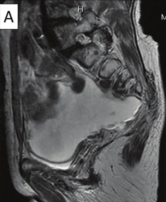 2 CaseReportsinObstetricsandGynecology (a) (b) (c) Figure 1: Magnetic resonance imaging (MRI) shows massive ascites and nodular/irregular thickening of the mesentery and peritoneum and a small mass