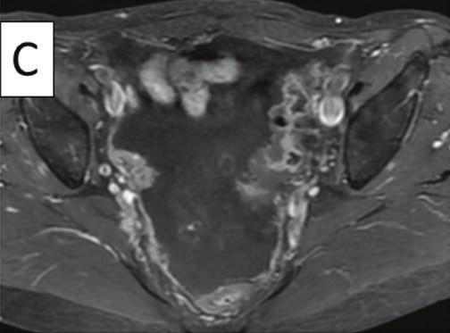 A PET- CT scan demonstrated elevated FDG uptake in the areas of nodular/irregular thickening in the mesentery and peritoneum, although elevated FDG uptake was not observed in the appendix.