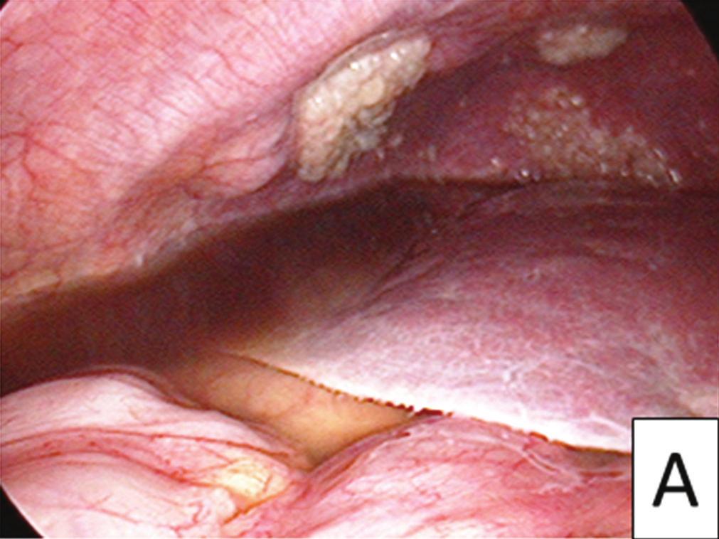 peritoneum due to cancerous tissue were observed.