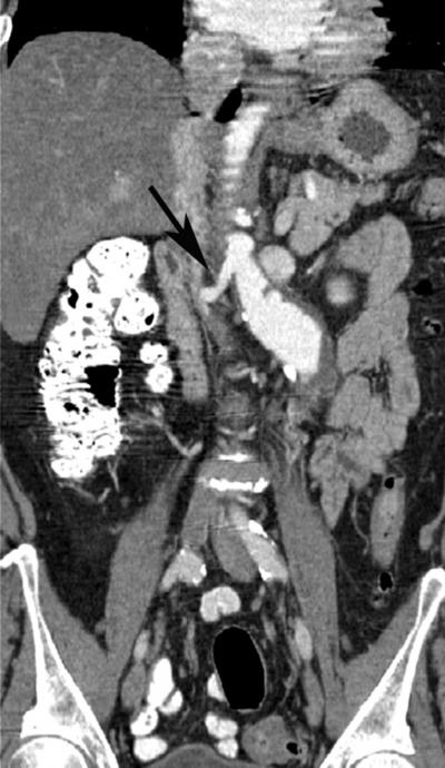 embolization of pelvic traumatic bleeding (5), and for pelvic surgery in general.
