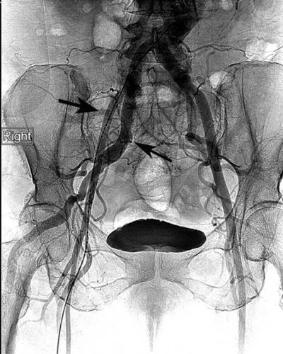 Figure 3 Figure 3: Angiogram of right-sided persistent sciatic artery. The SFA marked with large arrow above and the PSA marked with small arrow below. isolated above the knee.