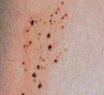 Test your knowledge with multiple-choice cases Case 1 What are these speckled spots? A speckled, pigmented lesion is noticed on the upper arm of a 10-year-old girl.
