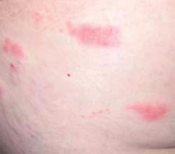 Case 2 It spread overnight! A 60-year-old woman presents with a rash that evolved overnight on her right side, where she had been experiencing sharp, burning pain for the previous two weeks.