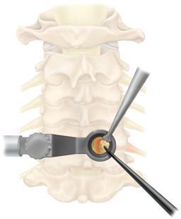 Minimally Invasive Spine Surgery Smaller pathways to decompress a nerve