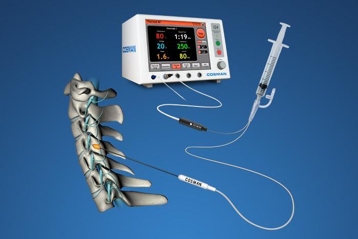 Minimally Invasive Ways to Control Pain Radiofrequency Ablation Pulsed RF Cooled RF How is it done Does it work.
