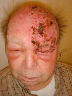 VZV: Clinical: primary varicella infection (C.