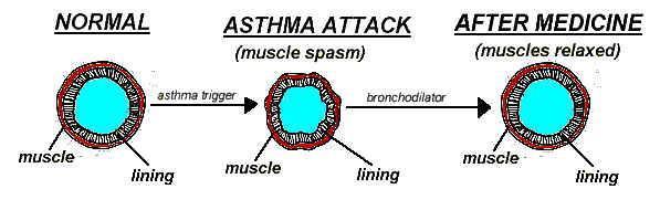 Obstructive diseases Asthma - A chronic inflammatory disorder which causes recurrent episodes of wheezing, breathlessness, cough and chest tightness.