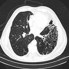 Bronchiectasis - Permanent dilation of bronchi and bronchioles.