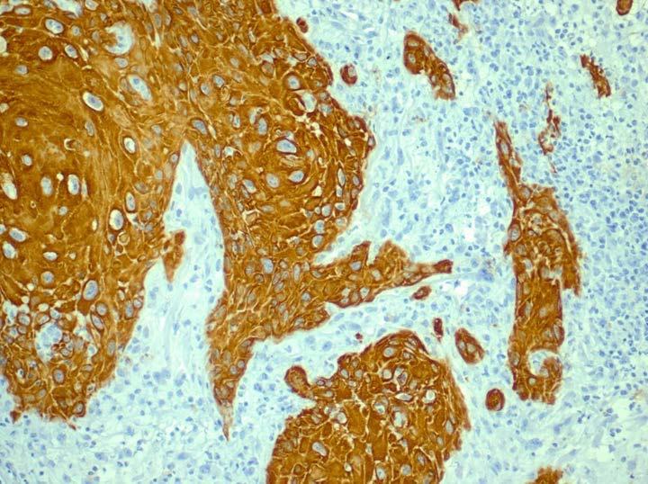 squamous cell carcinoma are highlighted
