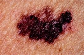 Detect Skin Cancer Early At least 95% of skin cancer can be cured if detected early.