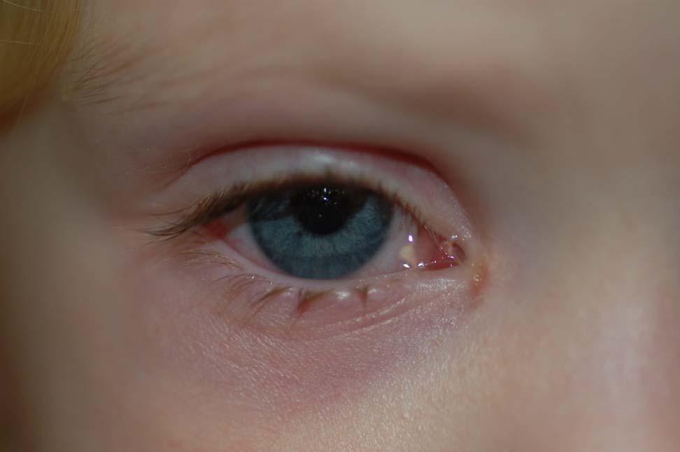 Types of Conjunctivitis Viral Allergic Bacterial Chlamydial Irritative