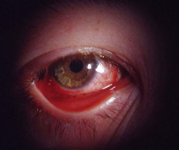 Viral Conjunctivitis Usually affects older children Usually unilateral, then affects fellow eye May be