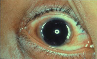 Vernal Keratoconjunctivitis Presents from early spring until