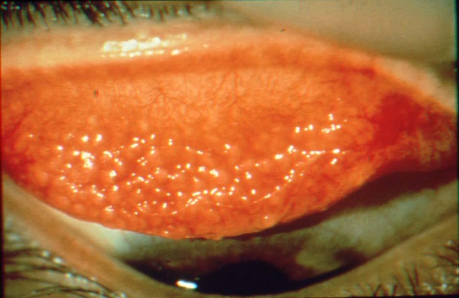 Giant Papillary Conjunctivitis Irritation, mucous discharge, hyperemia Deposits on soft contact lenses