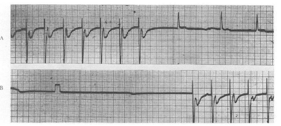 External defibrillation, Zoll, NEJM 1956