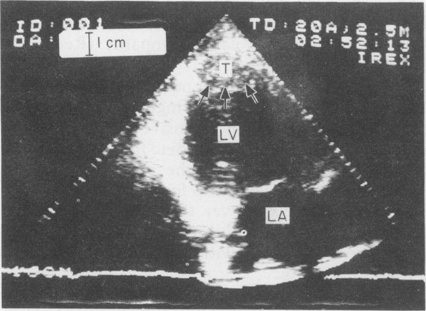 Left ventricular thrombi after myocardial infarction 497 TABLE 2.