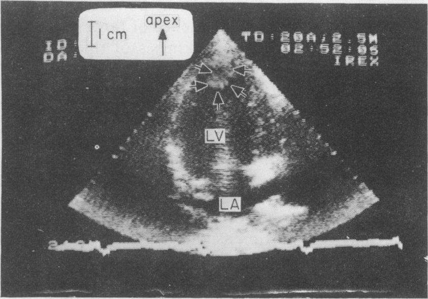 mural; P = protruding; A = akinesis; H = hypokinesis. *commenced after thrombus detection; tdied; ::Systemic embolism. FIG. 1. Apical two-chamber view (Case 6). Arrows denote thrombus (T) at the apex.