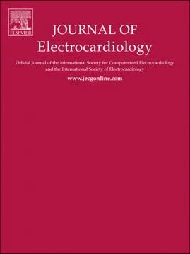 , Babaeizadeh Saeed, Identification of Exercise Induced Ischemia using QRS Slopes, Journal of Electrocardiology (2015), doi: 10.1016/j.jelectrocard.2015.09.