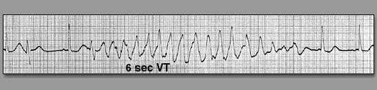 64 yr female, RHD ; on AADs In the ICU that night Short- long short cycles in the background of QT What went