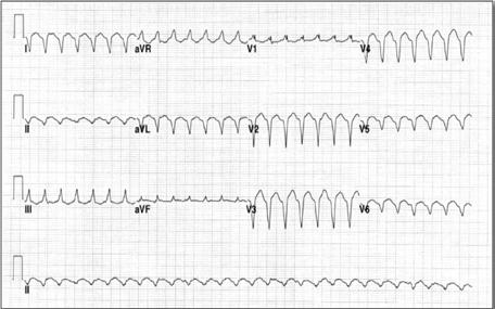 1/25 of a second d. 0.1 millivolt Ans. b, c The verticle millimeter of ECG paper measures? a. 0.04 seconds b. 1 millivolt c. 0.1 millivolt d. 0.01 millivolt Ans.